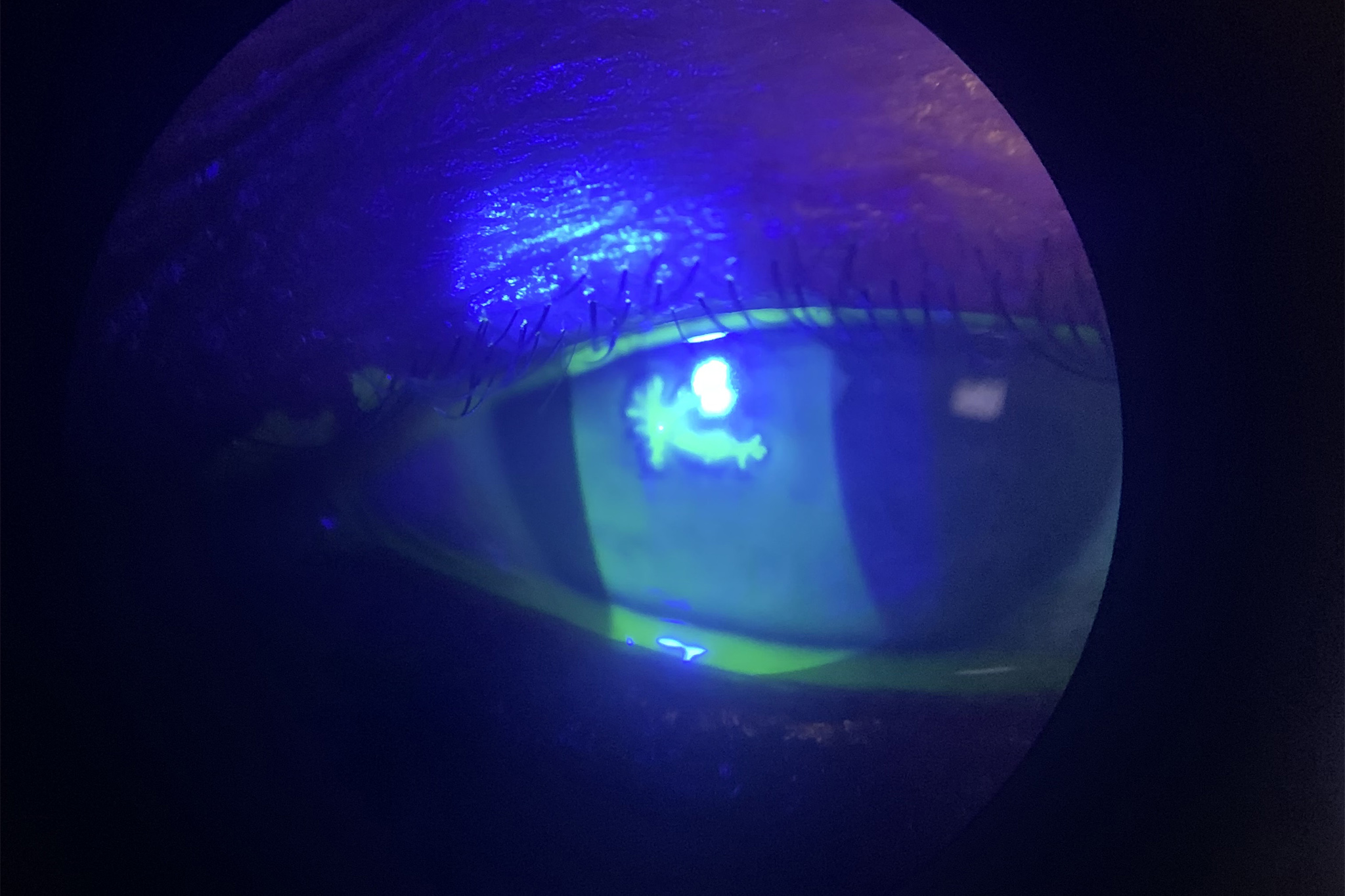 Ocular Conditions Tarboro Eye Associates